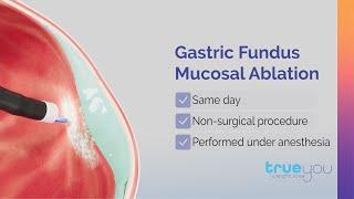 Gastric Fundus Mucosal Ablation (GFMA) Animation