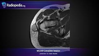 Morel-Lavallée lesion - radiology video tutorial (MRI, ultrasound)