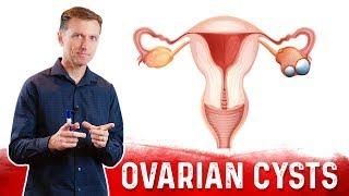 Ovarian Cysts: Causes, Symptoms & Natural Treatment – Dr.Berg