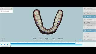 Our different 3D Treatment Plans || Clear Moves Aligners