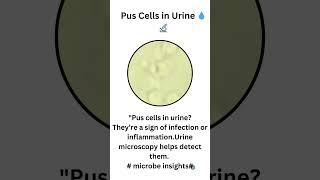 Cloudy urine Time to check for pus cells! #PusCells #UrineMicroscopy #UTISymptoms #UrineAnalysis