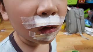 접촉성피부염 입술 치료 증상 더럽게 오래걸림