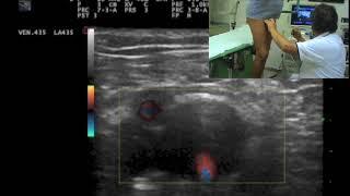 A case of recurrence after stripping without escape point (negative Valsalva)