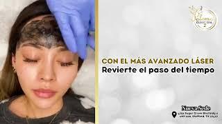 Tratamiento Hollywood laser peel #tratamientofacial #palomaclinicspa #belleza #houston #texas