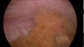 Cystolithalapaxy Short Clip