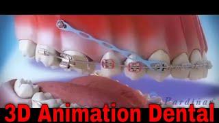 Fall in love with Dentistry MyDentCart | Dental Animation Patient Education 3D Video Dental 3D Video