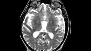 Degenerative Disease Motor neuron disease