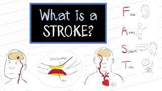 What is a Stroke? (HealthSketch)