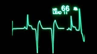 Звук остановки сердца #cardio #сердце #медицина #жизнь #жиза #топ