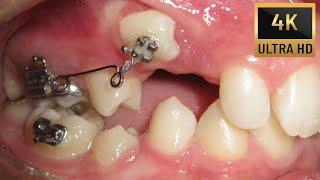 HOW #BRACES WORK #timelapse of IMPACTED maxillary Canine and Premolar  GEMINATION! #4k