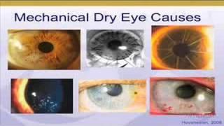 Dry Eye Treatment Part IV, John Hovanesian MD Harvard Eye