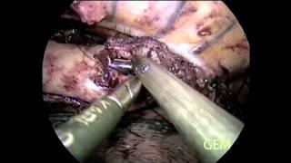 SS15 Best of Video:V034. MINIMALLY INVASIVE ESOPHAGO-GASTRECTOMY WITH INTRA THORACIC ANASTOMOSIS