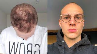 Going Bald In My 20's - Why I Accepted My Hair Loss And Shaved My Head