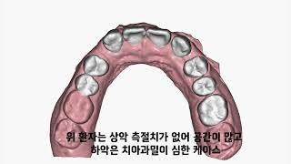 D1 Dental 디원치과 아미절라인 AMIsalign 투명교정 정*진 님 케이스리포트