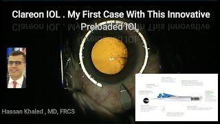 Clareon IOL, my first case with this innovative delivery system.