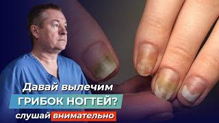 ШОКИРУЮЩАЯ ПРАВДА ПРО ГРИБОК НОГТЕЙ! Как вылечить ОНИХОМИКОЗ самостоятельно?