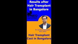 Best Hair Transplant Results in India | Hair Transplant Cost in Bangalore | Hair Transplant