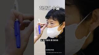 중년 눈성형  하안검 상담받고 수술한 2달차 후기 (미호 시그니처 눈밑성형)