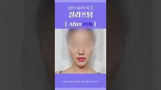 #shorts 실리프팅 효과 살펴보기! 피부 처짐 문제는 이것으로 해결!
