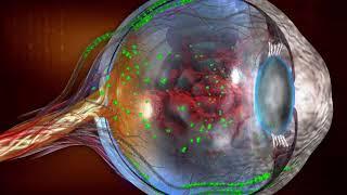 Exploring Alternative Treatments for Optic Nerve Damage