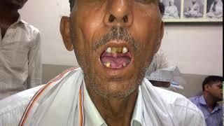 BULBAR PALSY PATIENT WITH TONGUE FASICULATIONS