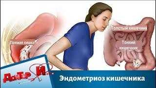 Эндометриоз кишечника | Доктор И