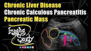 Chronic Liver Disease - Chronic Calculous Pancreatitis - Pancreatic Mass || Ultrasound || Case 189