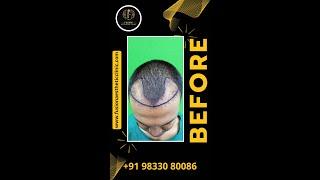 Repair Hair Transplant Result || Dr. Pranil More || Fusion Aesthetic Clinic ||  गंजेपन से छुटकारा