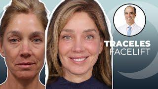 How I look After a Traceless Facelift | Dr. David Stoker