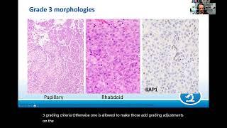 AANP Teaching Rounds - March 28 - Common Mesenchymal Neoplasms in and around the CNS