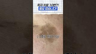 흑자를 한번에?! 10번 받지 마세요! #흑자제거 #흑자  #색소침착