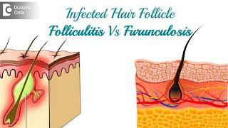 Infected hair follicle. What to do? Causes, Location, & Treatment-Dr. Rasya Dixit | Doctors' Circle