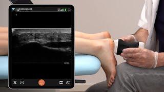 Ultrasound of the Plantar Fascia