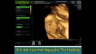 EM BÉ CỦA MẸ NGUYỄN THỊ HƯƠNG - MÊ LINH  HÀ NỘI - THAI 24 TUẦN 1 NGÀY