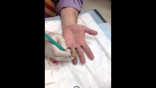 Dr drains his own finger