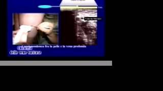 Vene Varicose: la chirurgia emodinamica. CHIVA, stripping,chirurgia vascolare, flebologia, veneinfor