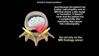 Sciatica Impersonators Explained: Top Causes, Symptoms, and Treatments You Must Know