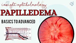 PAPILLEDEMA || OPTIC DISC SWELLING || EXPLAINED ||