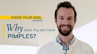 Why do I have pimples? |  Acne prone skin care  |  Skin imperfections