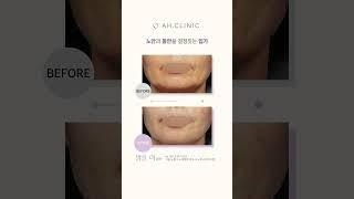 입가주름, 노안과 동안을 결정짓는 주름! 콜라겐 주사로 개선해 보세요.