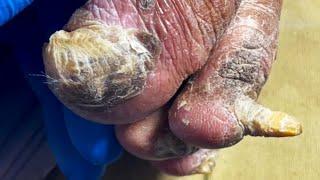 This Toenail Is Seriously Deteriorated  Be Careful To Cut Off The Bad Nails【Pedicure Master Lin Jun】