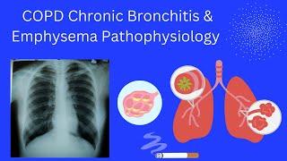 COPD Chronic Bronchitis & Emphysema Pathophysiology