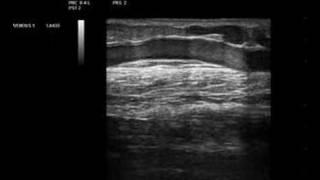 Phlebology- Biosound Esaote MyLab 25 Accessory Saphenous 2D