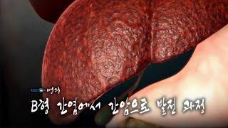 [명의 의학백과] B형 간염에서 간암으로 발전 과정