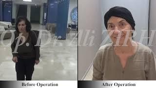 Famila SÜLEYMANOVA / Before and After Surgery Parkinson's Treatment DBS in Turkey