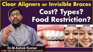 Advantages of Invisalign | Invisible Braces Cost in Hyderabad || Eledent Dental Hospitals