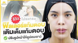 รีวิวฟิลเลอร์แก้มตอบ แก้ปัญหากระเปราะแก้ม ใบหน้าหย่อนคล้อย