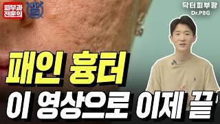 여드름 패인 흉터도 없앨 수 있을까? 여드름 흉터 전문가가 알려드리는 치료 방법 - 피부과전문의 닥터피부광, 의학박사 피부과전문의 전지훈