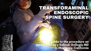 My technique for transforaminal endoscopic spine surgery