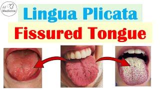 Lingua Plicata (Fissured, Grooved Tongue) | Causes, Complications, Treatment